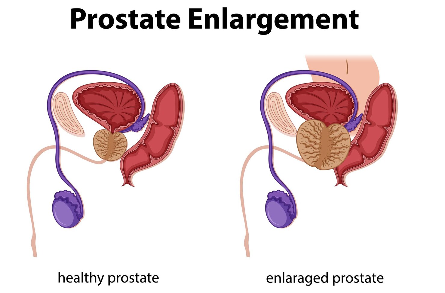 Early Signs of Prostate Disease You Should Never Ignore