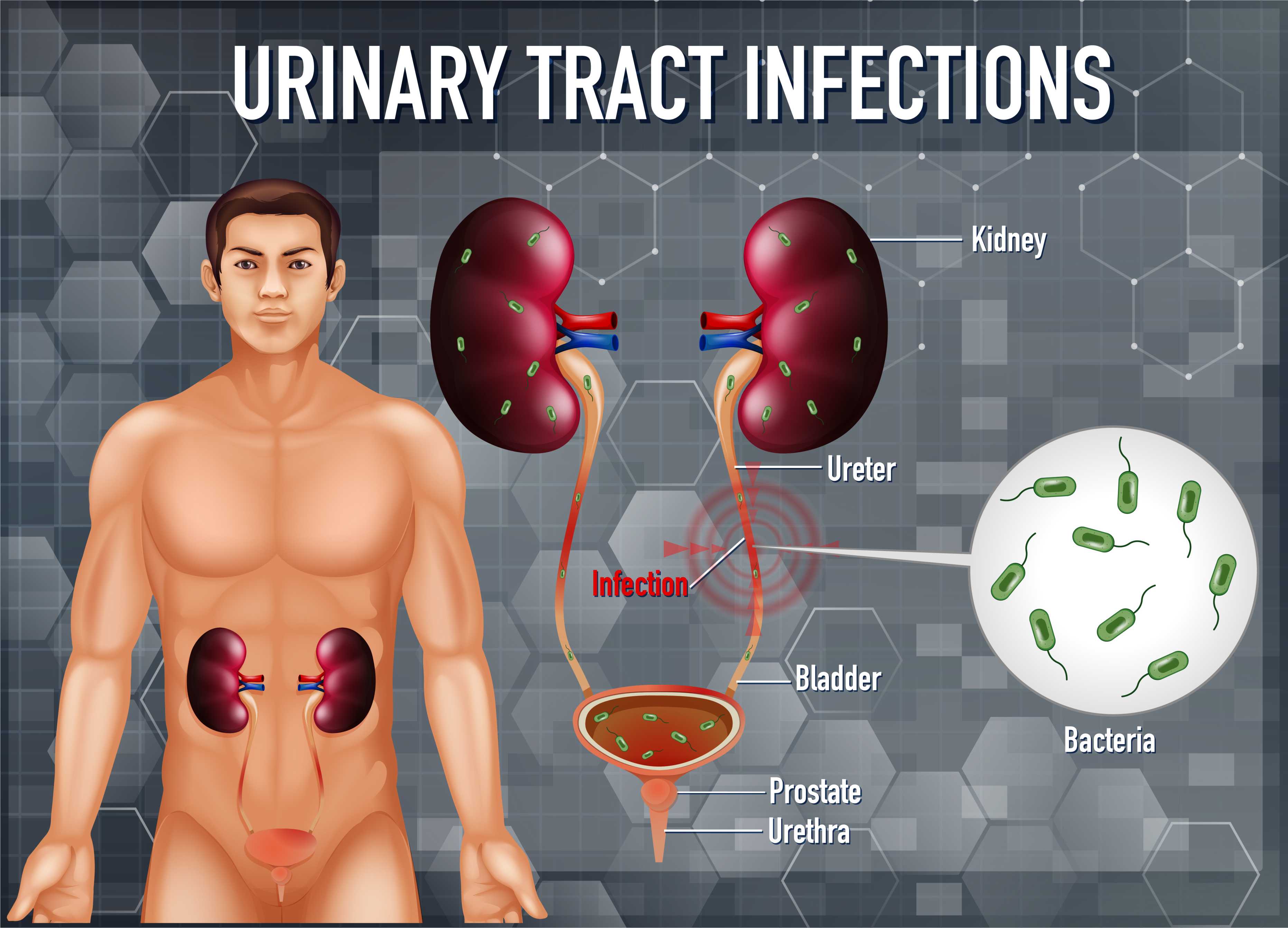 Urinary Tract Infections in Men
