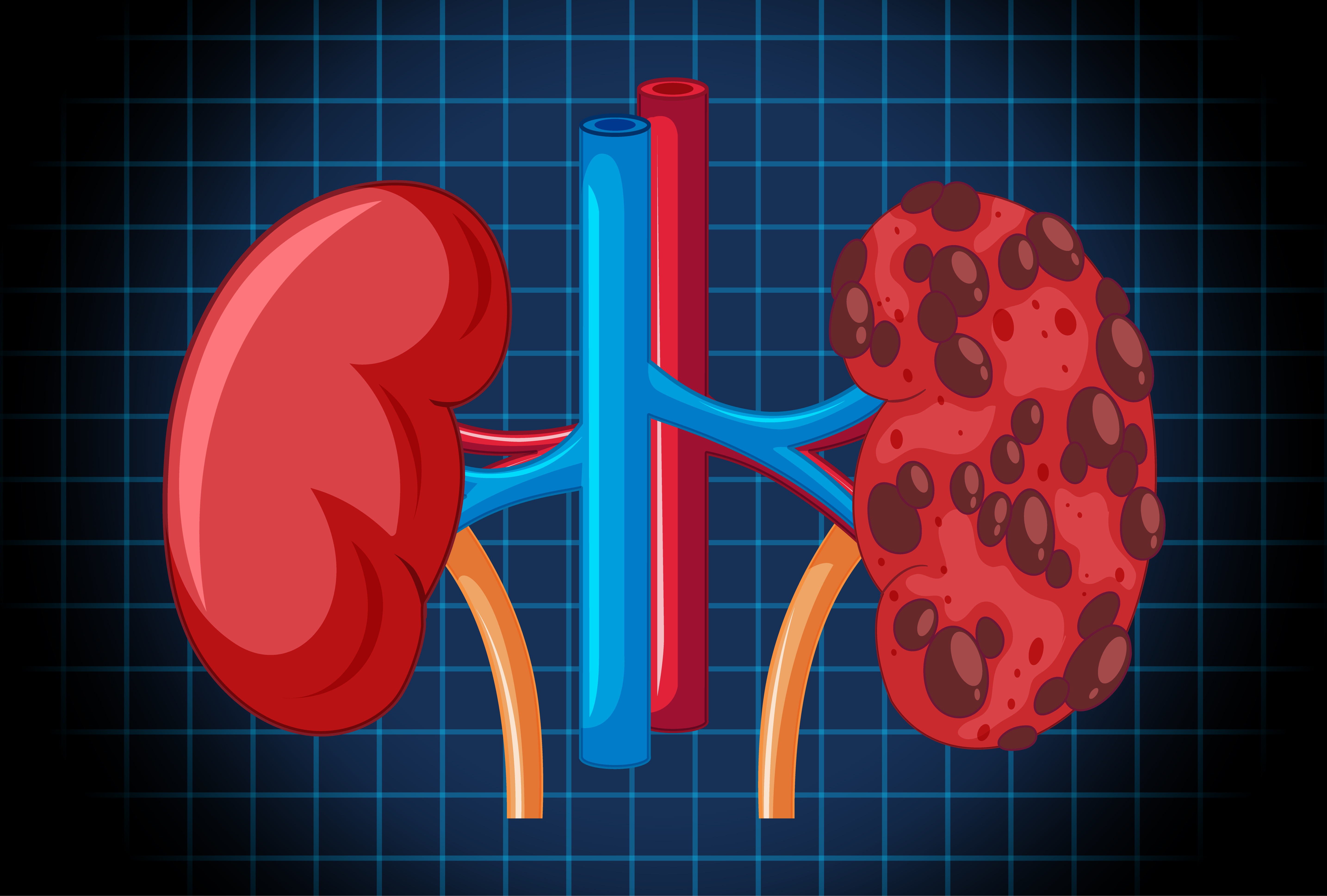 Early detection of PKD signs in kidneys
