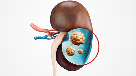 Kidney Stone Laser Treatment – Safe, Advanced & Effective Care