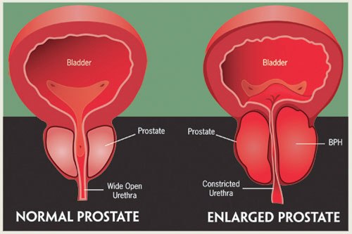 Why the prostate becomes enlarged